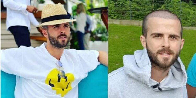 I Miralem Pjanić transplantirao kosu, koliko ovaj zahvat košta?