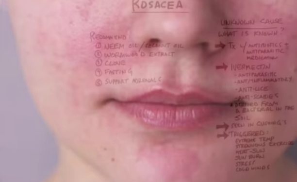 Rozacea- bolest kože najčešće sredovečnih žena bele puti