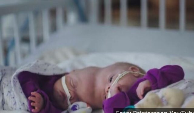 ROĐENE SU SA SPOJENIM GLAVAMA I SAMO 2 ODSTO ŠANSE DA PREŽIVE: Evo kako danas izgledaju