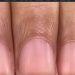 Dermatolog je otkrio šta znače neravnine na vašim noktima i da li su opasne