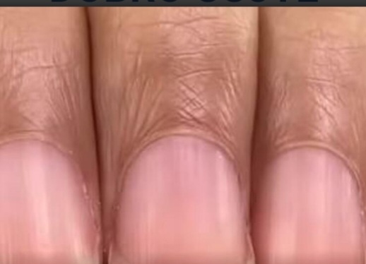 Dermatolog je otkrio šta znače neravnine na vašim noktima i da li su opasne