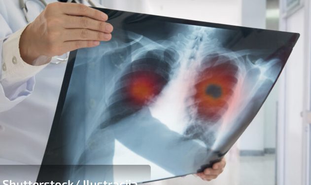 Koji su simptomi velikoga kašlja, koji delovi zemlje su pred epidemijom