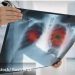 Koji su simptomi velikoga kašlja, koji delovi zemlje su pred epidemijom