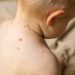 Novi haos na pomolu sa epidemijom morbila, nedopustivo da djeca umiru