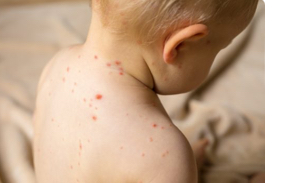 Novi haos na pomolu sa epidemijom morbila, nedopustivo da djeca umiru