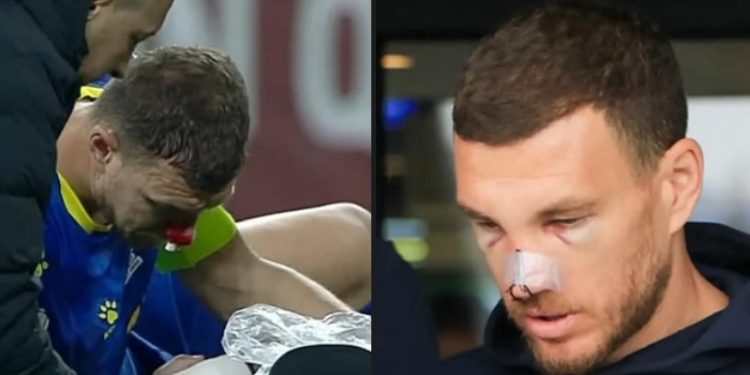 Edin Džeko: Kapiten koji nikada ne odustaje, konci na nosu a modrica na oku