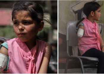 Gubitak ruke palestinske djevojčice predstavlja teške traume nakon bombardovanja cionista