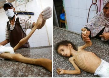 Malena Razan umrla zbog nedostatka hrane, više od 70 djece umrlo iz istih razloga