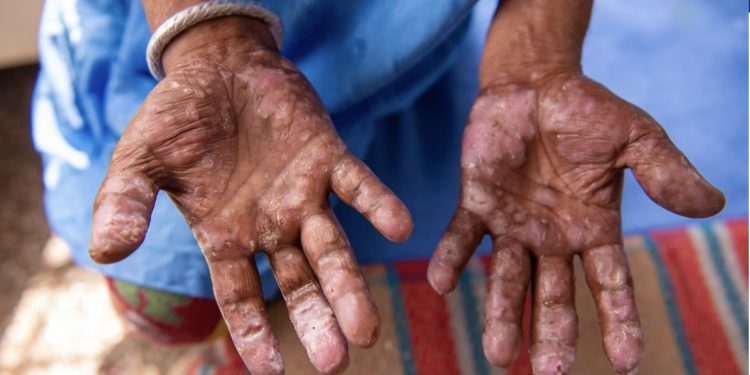 U Hrvatskoj i Rumuniji potvrđena kuga – šta je i kako se liječi