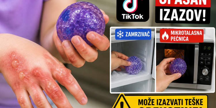 Opasan TikTok trend zabrinuo roditelje: Djeca zadobijaju teške opekotine zbog antistres igračke